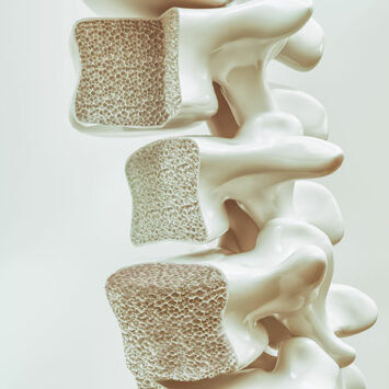 Osteoporoze